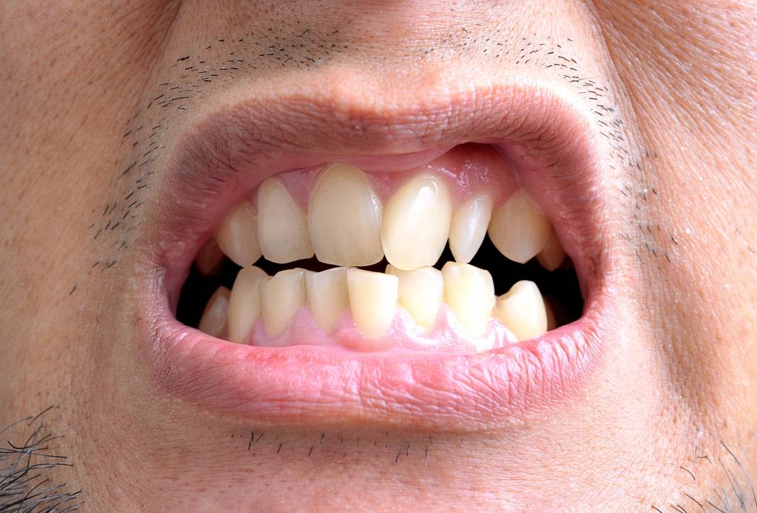 Binlerce yıllık sır ortaya çıktı: Dişlerinizin çarpık olmasının suçlusu belli oldu! 6
